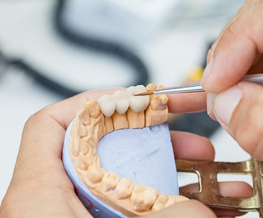 Dental bridge on plaster tooth model