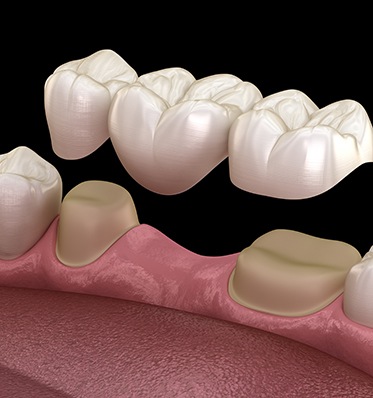 Illustration of traditional dental bridge