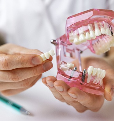 Dentist using model to explain implant bridge