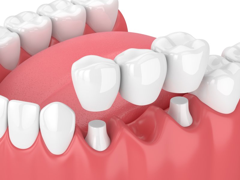 Illustration of dental bridge